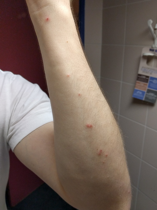 Bites on an arm from Bed Bugs